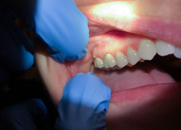 Best Broken or Chipped Tooth Repair in Spring Grove, IL